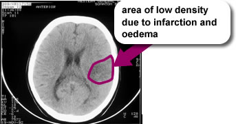 A CT scan with a caption that reads 'area of low density due to infarction and oedema' 