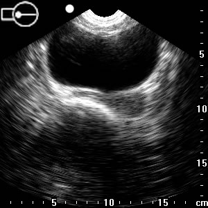 A scan of Edith's bladder
