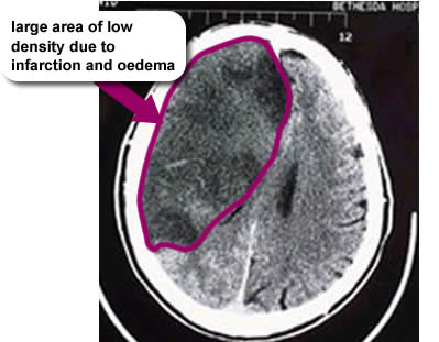 A brain scan that has a caption 'large area of low density due to infarction and oedema