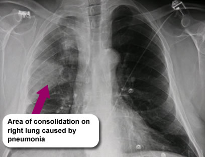 An x-ray of Archie's chest, showing an area of consolidation on the right lung caused by pneumonia
