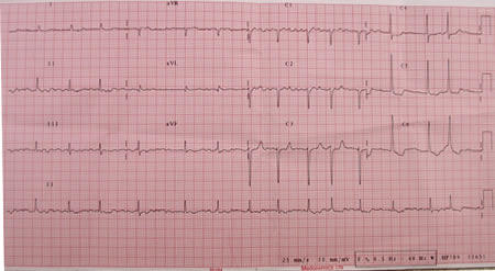 An ECG scan