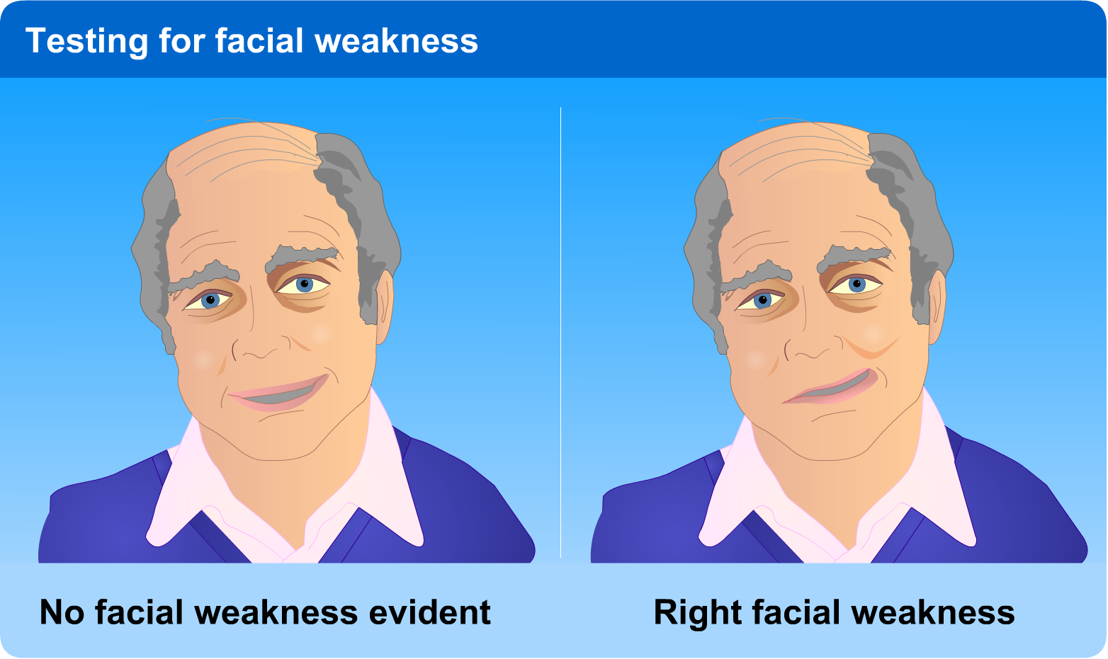 No facial weakness evident where both sides of mouth smiling equally. Right facial weakness evident where left side of mouth smiles but right does not.