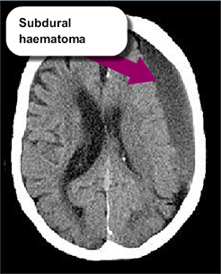CT scan showing Subdural haematoma