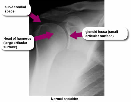 A x-ray of a 'normal shoulder' with captions pointing to; 'sub-acrominal space' 'head of humerus (large articular surface) and 'glenoid fossa (small artictular surface)