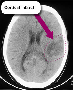 A copy of Isa's CT brain scan