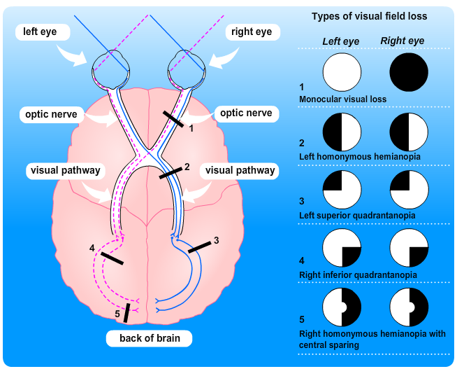 A diagram illustrating visual field loss; a horizontal cross-section of the brain as viewed from above - see view text alternative for description