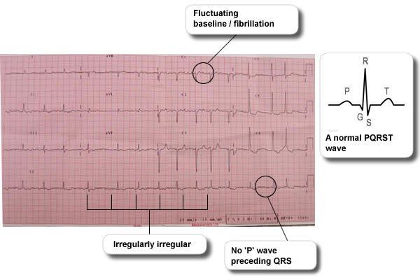 A copy of an ECG scan