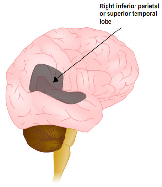 side-on diagram of brain highlighting right inferior parietal or superior temporal lobe