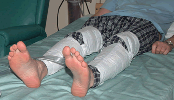 Intermittent Pneumatic Compression - person lying in bed