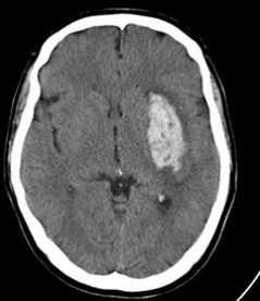 Jimmy's CT scan
