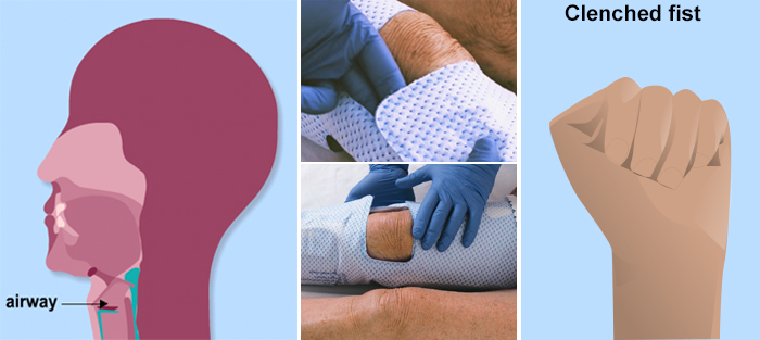 Collage of images including a diagram of the human airway, IPC equipment, and a clenched fist