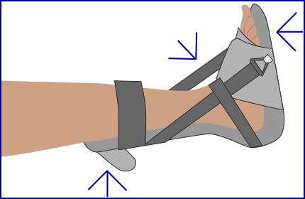 three-point night splint diagram showing support being applied to calf, sole, and ankle