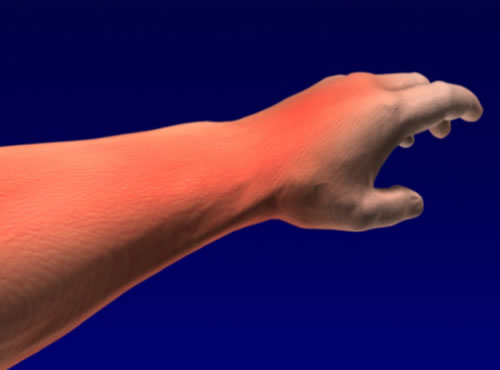 Arm - ┬® NAPP Pharmaceuticals