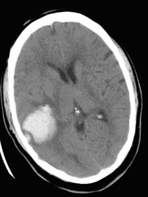 CT scan showing haemorrhage