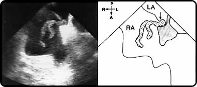 A large clot going through patent foramen ovale