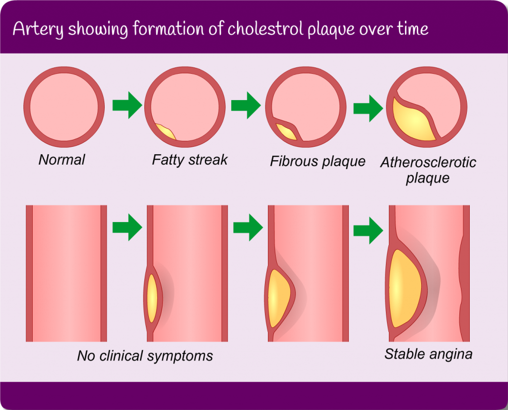 Artery showing formation of cholestrol plaque over time