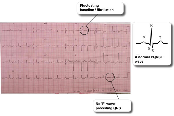 ECG scan showing Atrial fibrillation