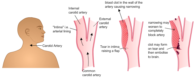 Section of corotid artery showing embolism