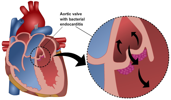 Heart showing close up section of aortic valve with bacterial endocarditis