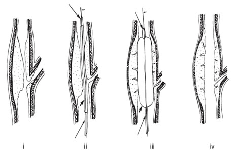 The principals of angioplasty