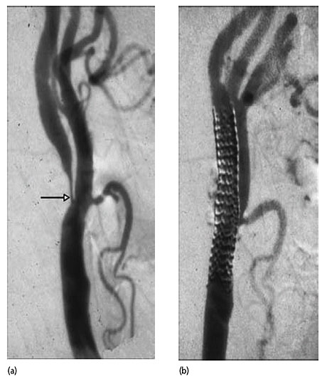 Catheter angiogram before (a) and after (b) stenting