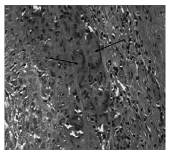 Giant cell arteritis