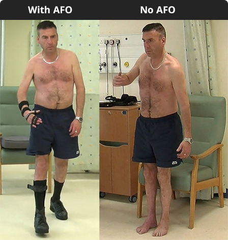patient with and without AFO in place