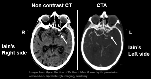 Iain's CT and CTA scans