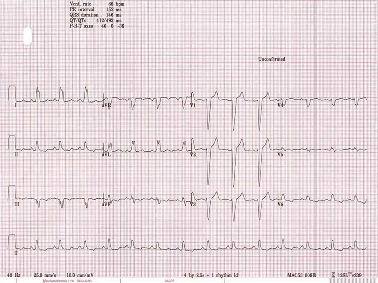LBBB ECG