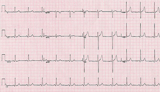 printout from Mary's ECG