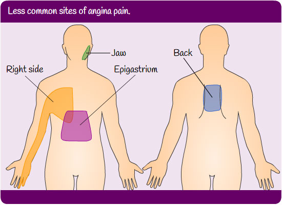 diagram showing less common sites of angina pain, including jaw, back, right side, and epigastrium