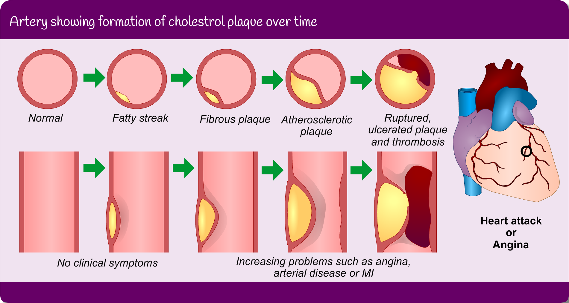 medical diagram with cutaways of blood vessels showing increasing formation of cholesterol plaque over time: see view text alternative for details