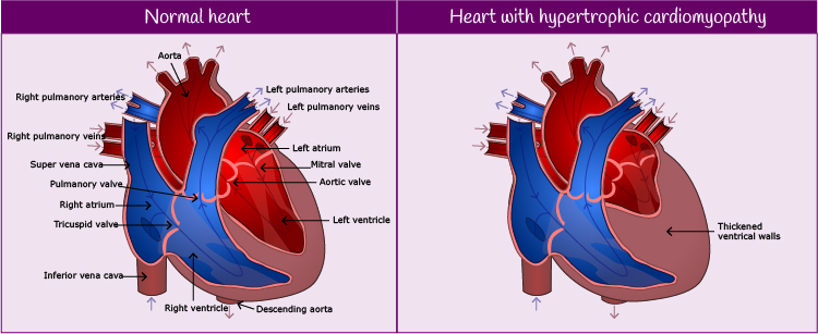 Normal heart and heart with hypertrophic cardiomyopathy