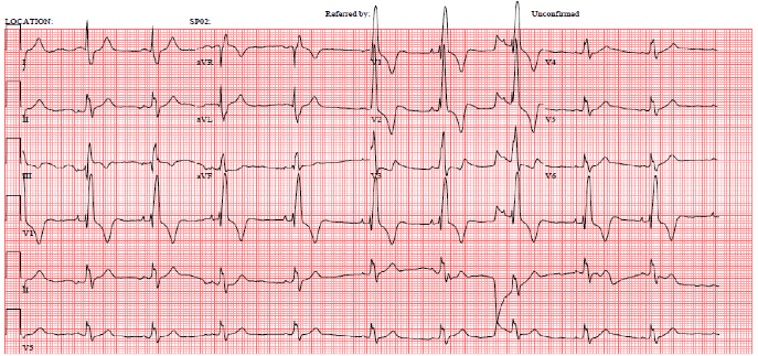 Kirsten's ECG