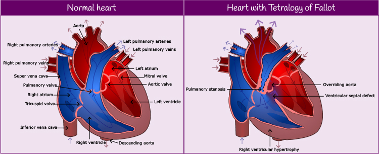 Normal heart and heart with Tetralogy of Fallot