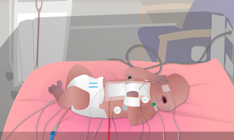 Baby Kirsten in hospital with lots of leads
