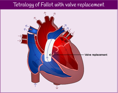 ToF heart with valve replacement