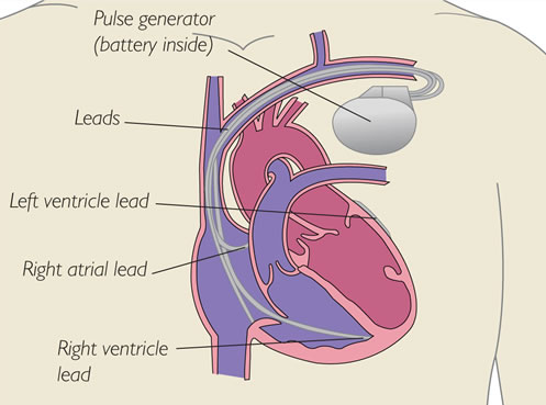 Section of heart showing location of pacemaker