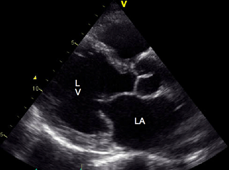 ECHO left atrium scan image