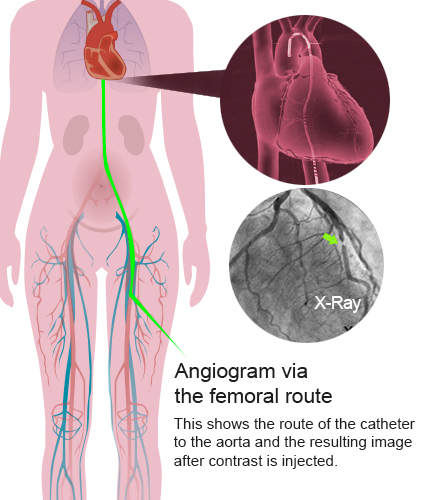 Angiogram via femoral route