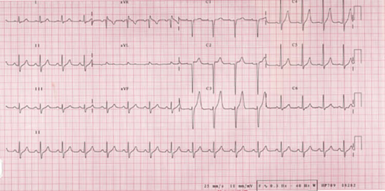 LBBB resolved ECG