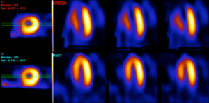 Perfusion Defect Mps Example Myocardial Perfusion Scintigraphy (MPS) - CHSS eLearning