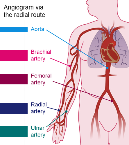Angiogram via radial route