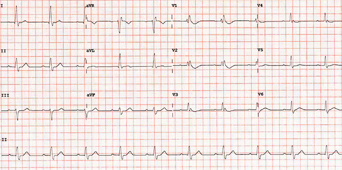 right bundle branch block graph