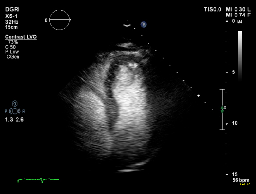 Stress echo 2
