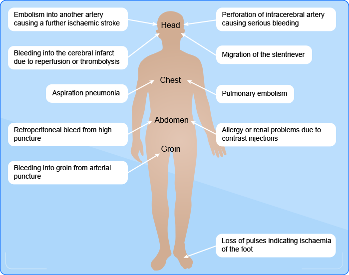 Possible complications of thrombectomy