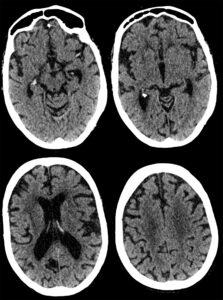 Case 01 CT head