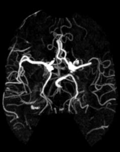 Case 01 CT Angiogram