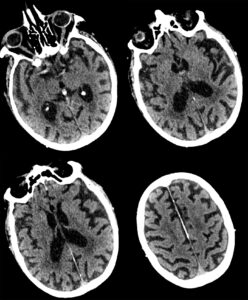 Case 02 CT