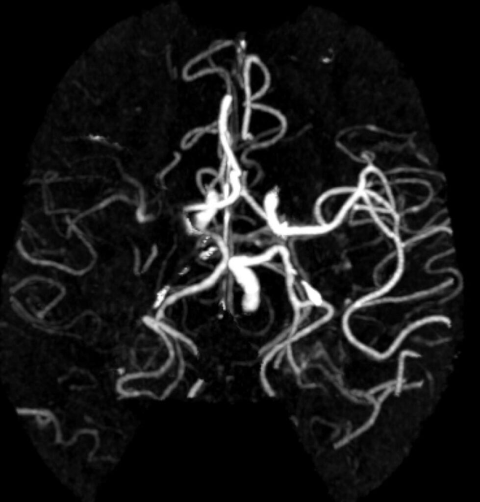 Case 02 CT Angiogram